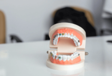 The Hidden Causes of Teeth Crowding and How to Prevent It