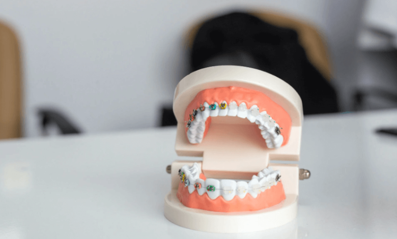 The Hidden Causes of Teeth Crowding and How to Prevent It